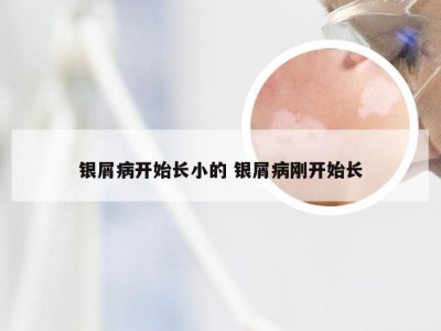 银屑病开始长小的 银屑病刚开始长