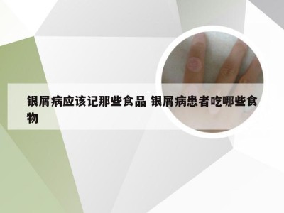 银屑病应该记那些食品 银屑病患者吃哪些食物