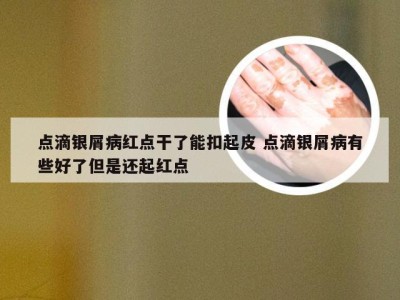 点滴银屑病红点干了能扣起皮 点滴银屑病有些好了但是还起红点