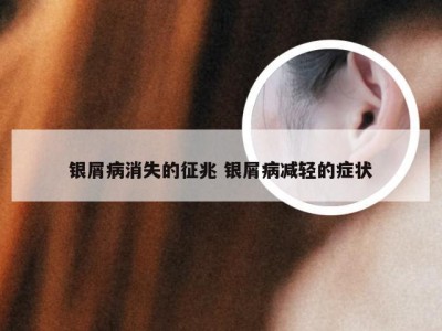 银屑病消失的征兆 银屑病减轻的症状