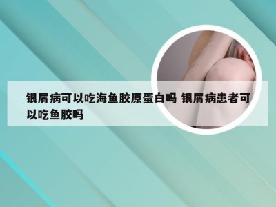 银屑病可以吃海鱼胶原蛋白吗 银屑病患者可以吃鱼胶吗