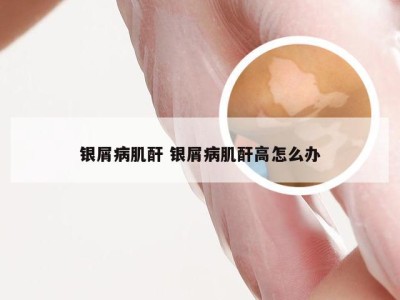 银屑病肌酐 银屑病肌酐高怎么办