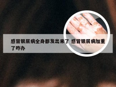 感冒银屑病全身都发出来了 感冒银屑病加重了咋办