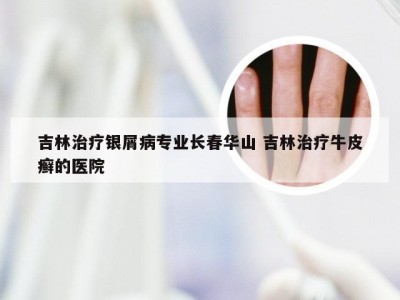 吉林治疗银屑病专业长春华山 吉林治疗牛皮癣的医院