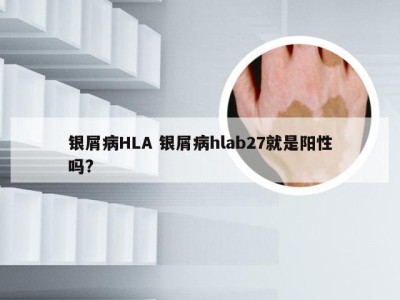 银屑病HLA 银屑病hlab27就是阳性吗?