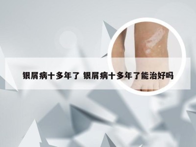 银屑病十多年了 银屑病十多年了能治好吗