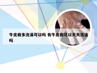 牛皮癣多洗澡可以吗 有牛皮癣可以天天洗澡吗