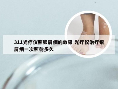 311光疗仪照银屑病的效果 光疗仪治疗银屑病一次照射多久