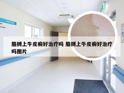 胳膊上牛皮癣好治疗吗 胳膊上牛皮癣好治疗吗图片