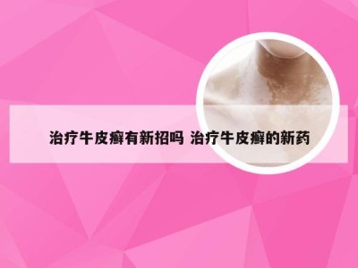 治疗牛皮癣有新招吗 治疗牛皮癣的新药