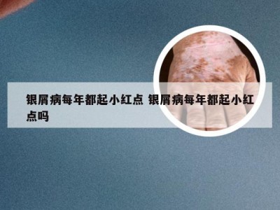 银屑病每年都起小红点 银屑病每年都起小红点吗