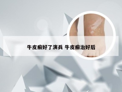 牛皮癣好了演兵 牛皮癣治好后