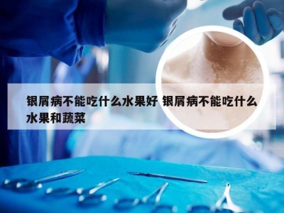 银屑病不能吃什么水果好 银屑病不能吃什么水果和蔬菜