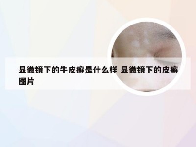 显微镜下的牛皮癣是什么样 显微镜下的皮癣图片