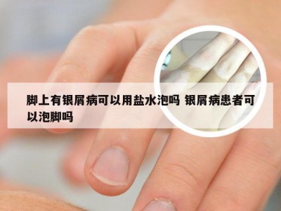 脚上有银屑病可以用盐水泡吗 银屑病患者可以泡脚吗