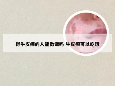 得牛皮癣的人能做饭吗 牛皮癣可以吃饭