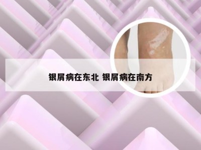 银屑病在东北 银屑病在南方