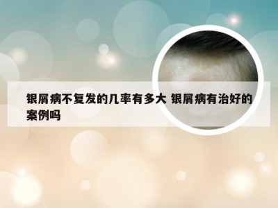 银屑病不复发的几率有多大 银屑病有治好的案例吗