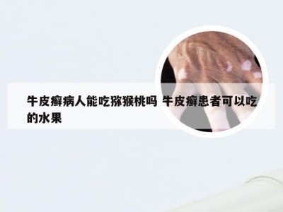 牛皮癣病人能吃猕猴桃吗 牛皮癣患者可以吃的水果