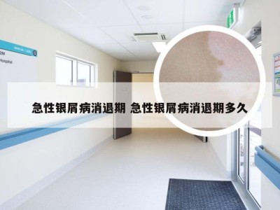 急性银屑病消退期 急性银屑病消退期多久