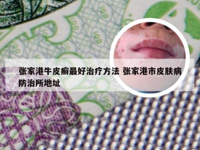 张家港牛皮癣最好治疗方法 张家港市皮肤病防治所地址