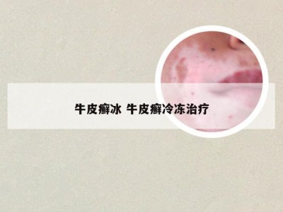 牛皮癣冰 牛皮癣冷冻治疗