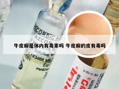牛皮癣是体内有毒素吗 牛皮癣的皮有毒吗