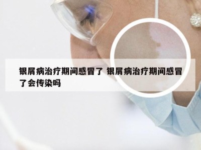 银屑病治疗期间感冒了 银屑病治疗期间感冒了会传染吗