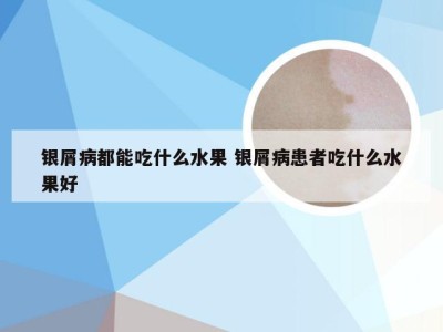 银屑病都能吃什么水果 银屑病患者吃什么水果好