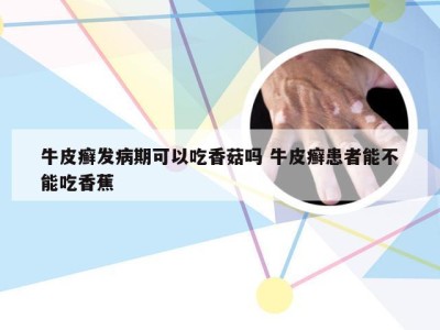 牛皮癣发病期可以吃香菇吗 牛皮癣患者能不能吃香蕉