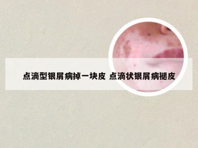 点滴型银屑病掉一块皮 点滴状银屑病褪皮
