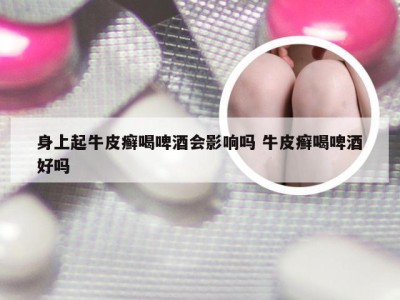 身上起牛皮癣喝啤酒会影响吗 牛皮癣喝啤酒好吗
