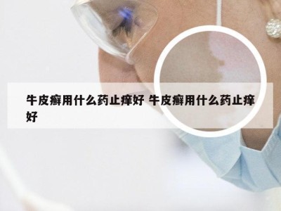 牛皮癣用什么药止痒好 牛皮癣用什么药止痒好