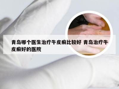 青岛哪个医生治疗牛皮癣比较好 青岛治疗牛皮癣好的医院