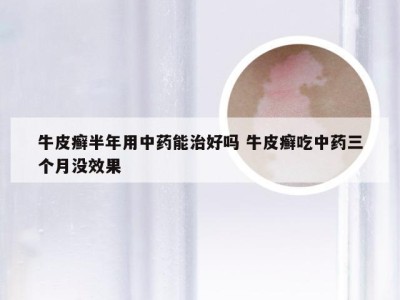 牛皮癣半年用中药能治好吗 牛皮癣吃中药三个月没效果