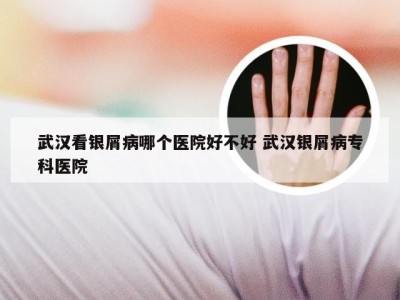 武汉看银屑病哪个医院好不好 武汉银屑病专科医院