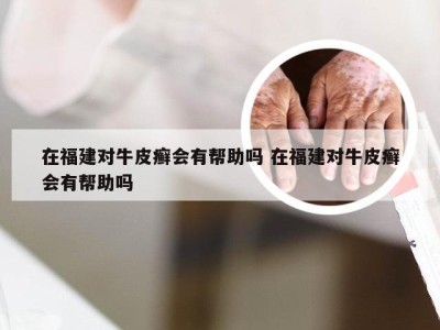 在福建对牛皮癣会有帮助吗 在福建对牛皮癣会有帮助吗
