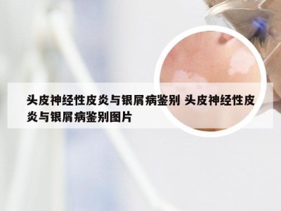 头皮神经性皮炎与银屑病鉴别 头皮神经性皮炎与银屑病鉴别图片