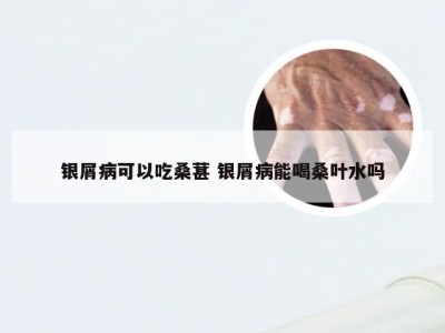 银屑病可以吃桑葚 银屑病能喝桑叶水吗