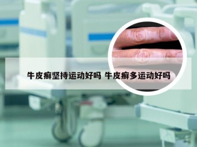 牛皮癣坚持运动好吗 牛皮癣多运动好吗