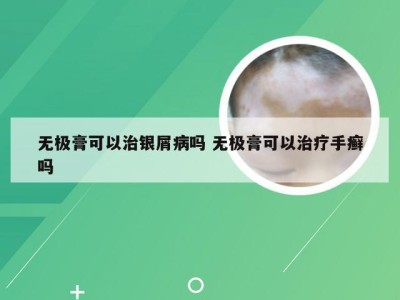 无极膏可以治银屑病吗 无极膏可以治疗手癣吗