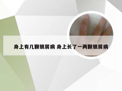 身上有几颗银屑病 身上长了一两颗银屑病