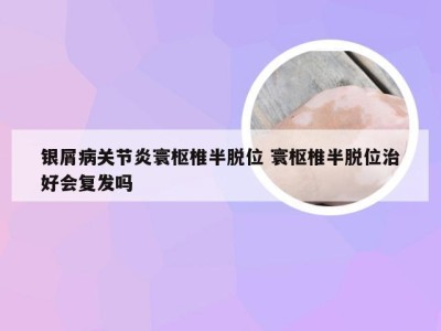 银屑病关节炎寰枢椎半脱位 寰枢椎半脱位治好会复发吗