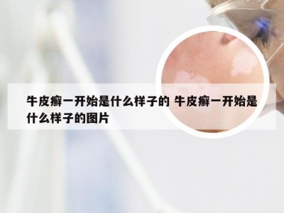 牛皮癣一开始是什么样子的 牛皮癣一开始是什么样子的图片