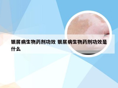 银屑病生物药剂功效 银屑病生物药剂功效是什么