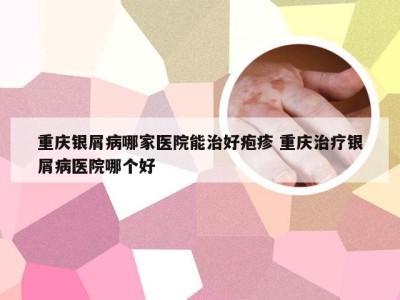 重庆银屑病哪家医院能治好疱疹 重庆治疗银屑病医院哪个好