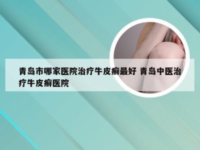 青岛市哪家医院治疗牛皮癣最好 青岛中医治疗牛皮癣医院