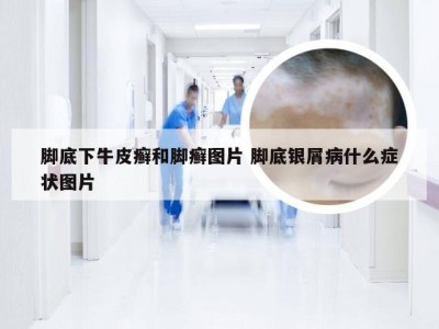 脚底下牛皮癣和脚癣图片 脚底银屑病什么症状图片
