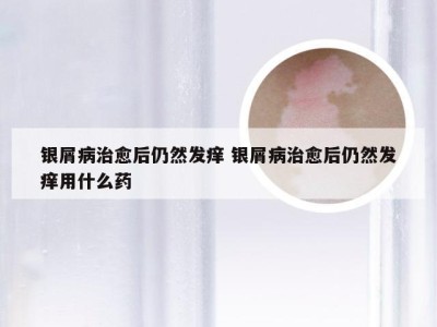 银屑病治愈后仍然发痒 银屑病治愈后仍然发痒用什么药