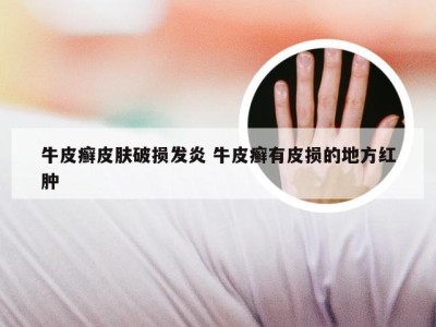 牛皮癣皮肤破损发炎 牛皮癣有皮损的地方红肿